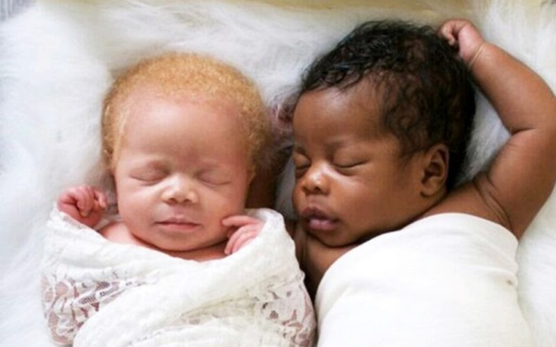  Темнокожий мальчик и девочка-альбинос: Необычная история рождения абсолютно разных двойняшек